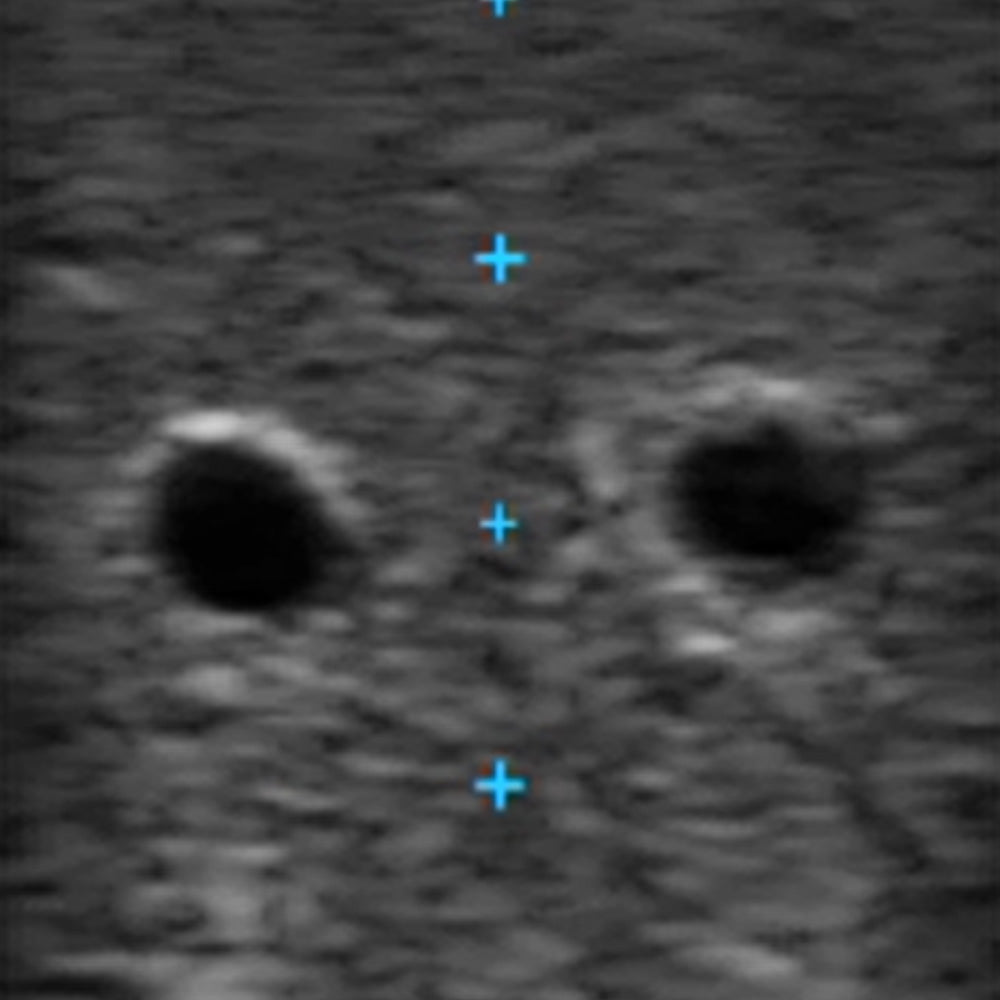 VASCULAR ACCESS ULTRASOUND PHANTOM - 3 Vein Superficial