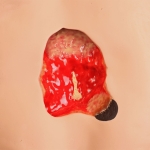 0910-detail-stageIV-ulcer-1000×1000