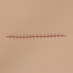3304_stapled_incision_lightly_pigmented_closeup-1000×1000